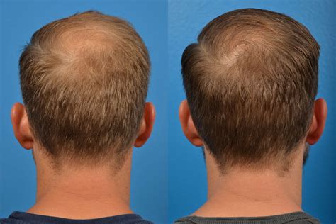 RESTORE Hair .